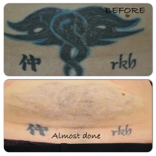 Full Removal — Motor City Tattoo Studio