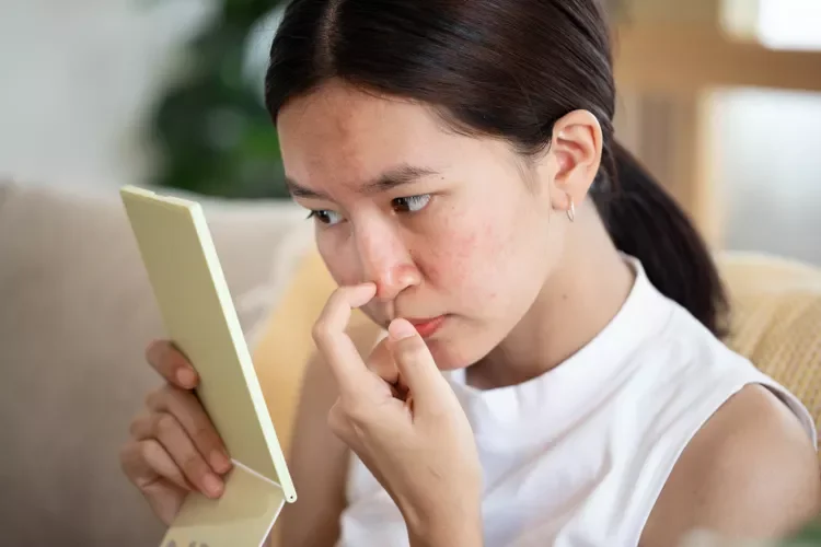 why-does-acne-itch-GettyImages-1462797605-9498f7c1cc4c4b19be9486fd7c629c07.webp