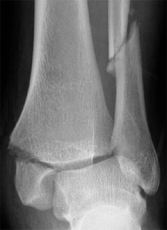 Ankle Fracture — Associate Professor Roderick Kuo