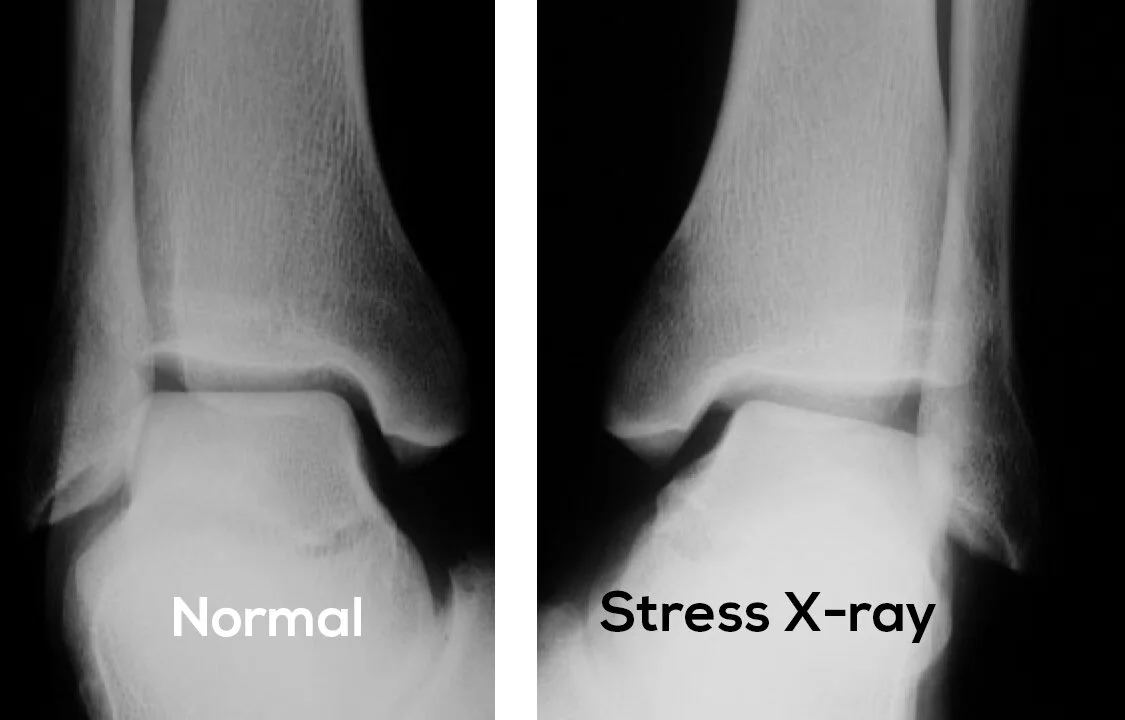 Ankle Sprains — Associate Professor Roderick Kuo