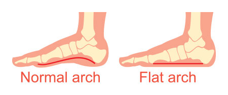 Flatfoot Deformity — Associate Professor Roderick Kuo