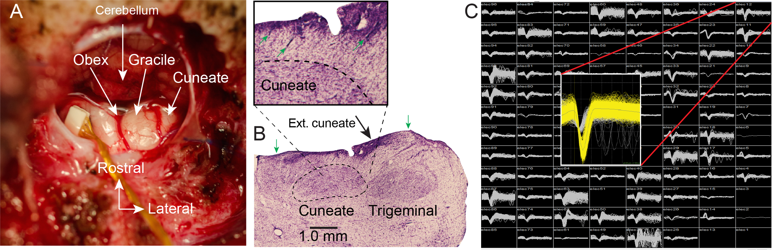 Fig 1: Electrode arrays implanted in dorsal brainstem yield single neuron recordings from the cuneate nucleus: A- Intraoperative exposure of the dorsal brainstem and cuneate nucleus following implantation of an FMA. The obex and cerebellar tonsils a…