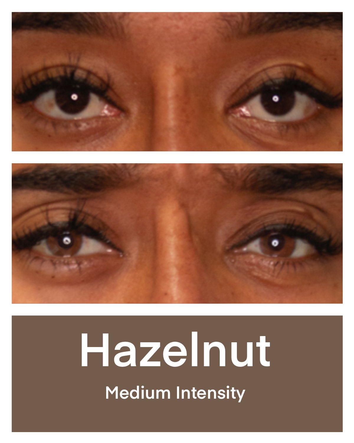 Kerato Procedure with Hazelnut Pigment
