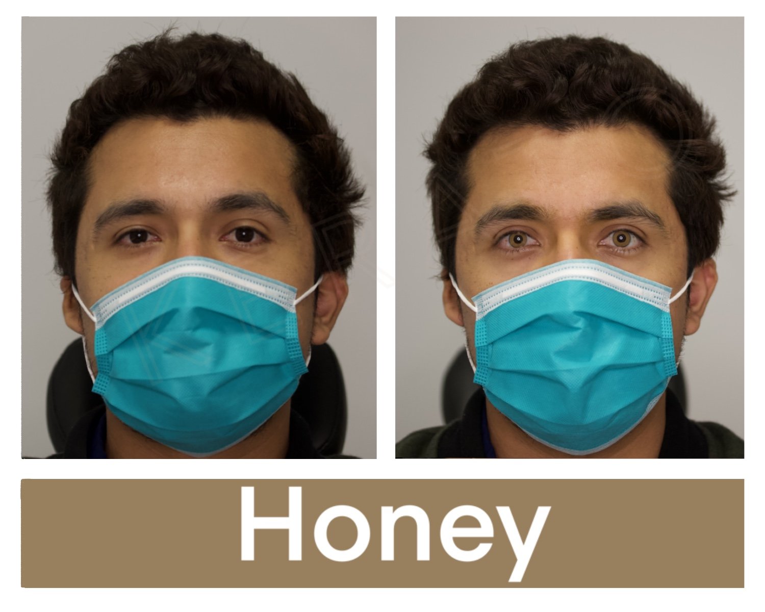 Kerato Procedure with Honey Pigment