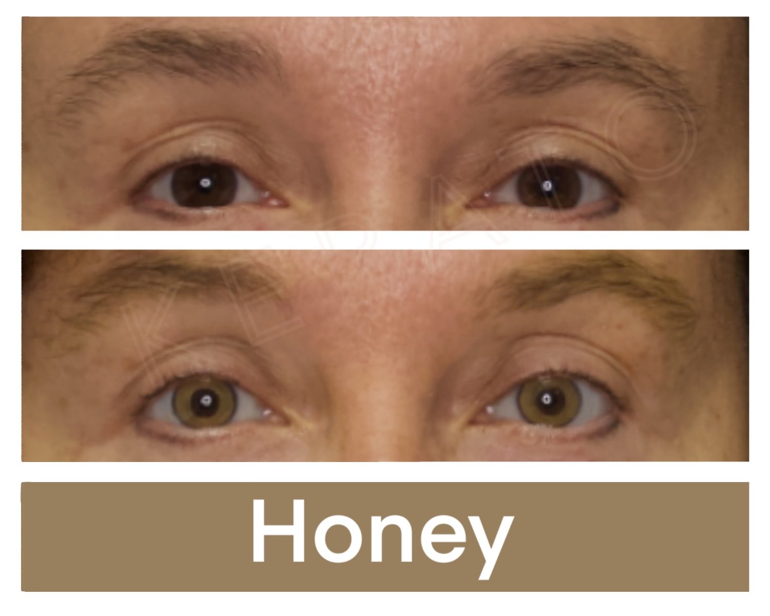 Kerato Procedure with Honey Pigment
