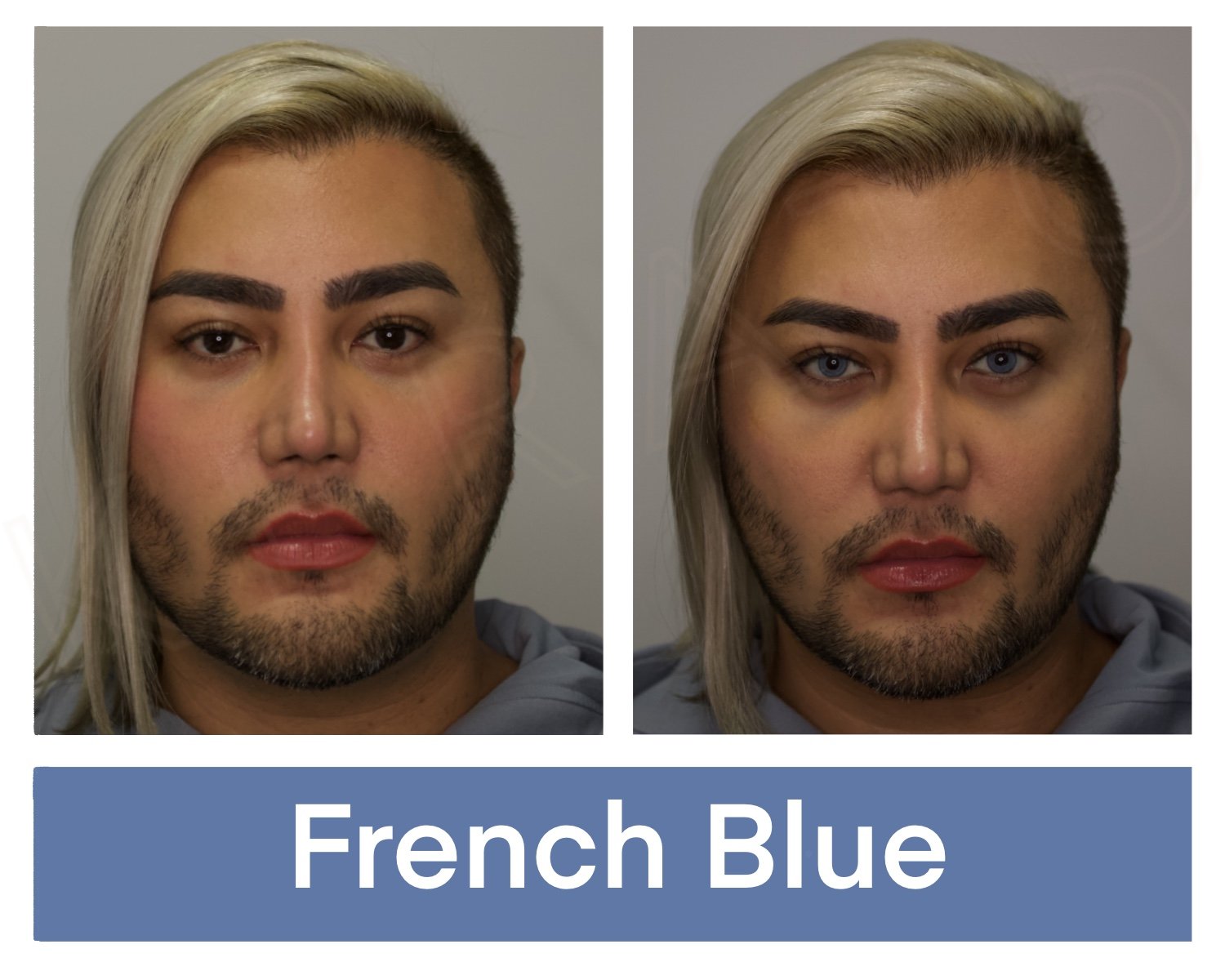 Kerato Procedure with French Blue pigment