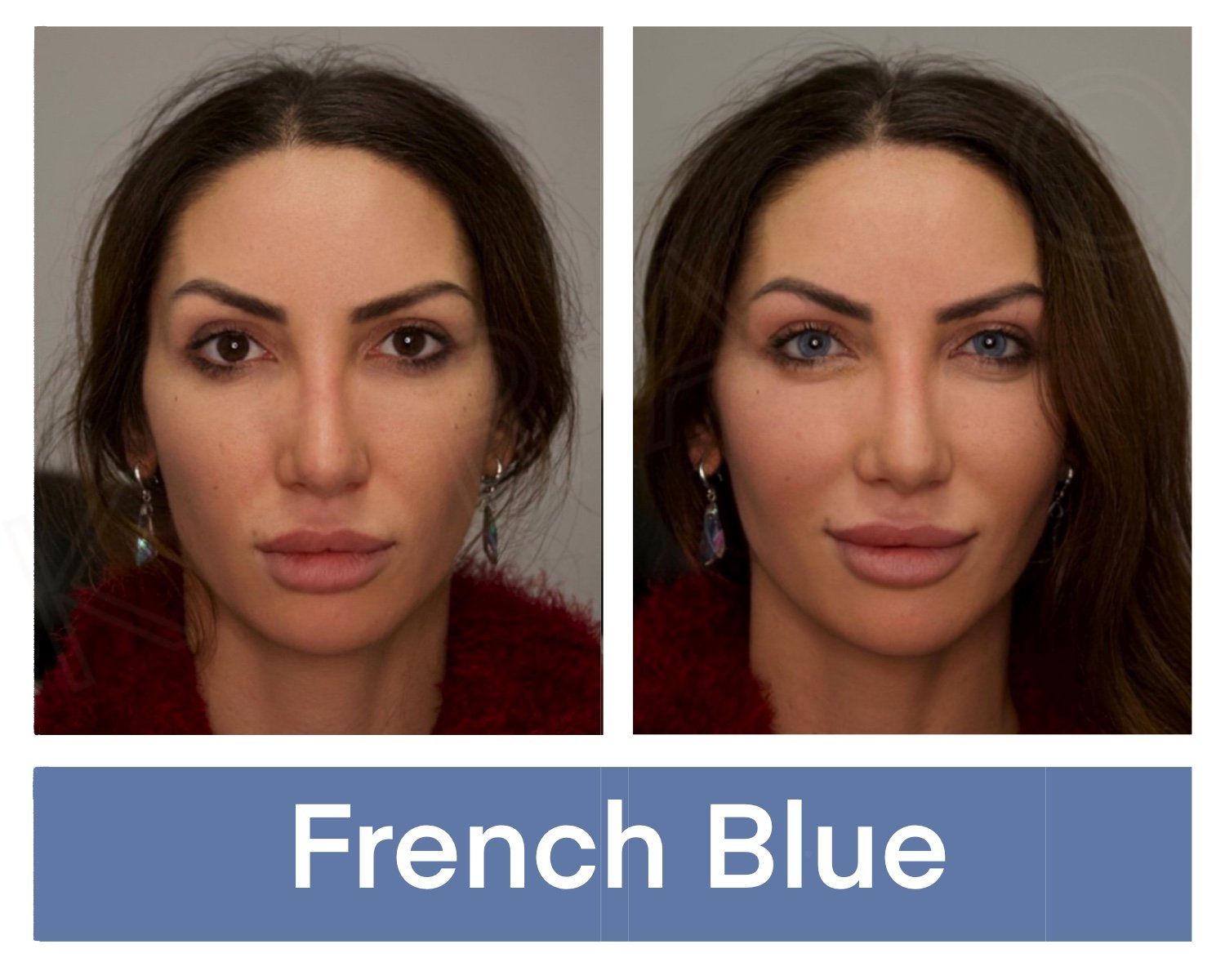 Kerato Procedure with French Blue Pigment