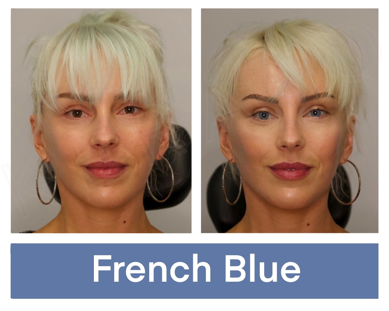 Kerato Procedure with French Blue Pigment