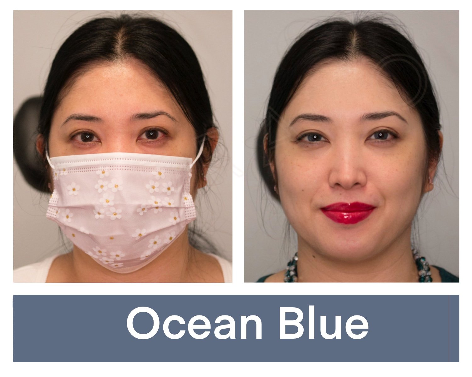 Kerato Procedure with Ocean Blue Pigment