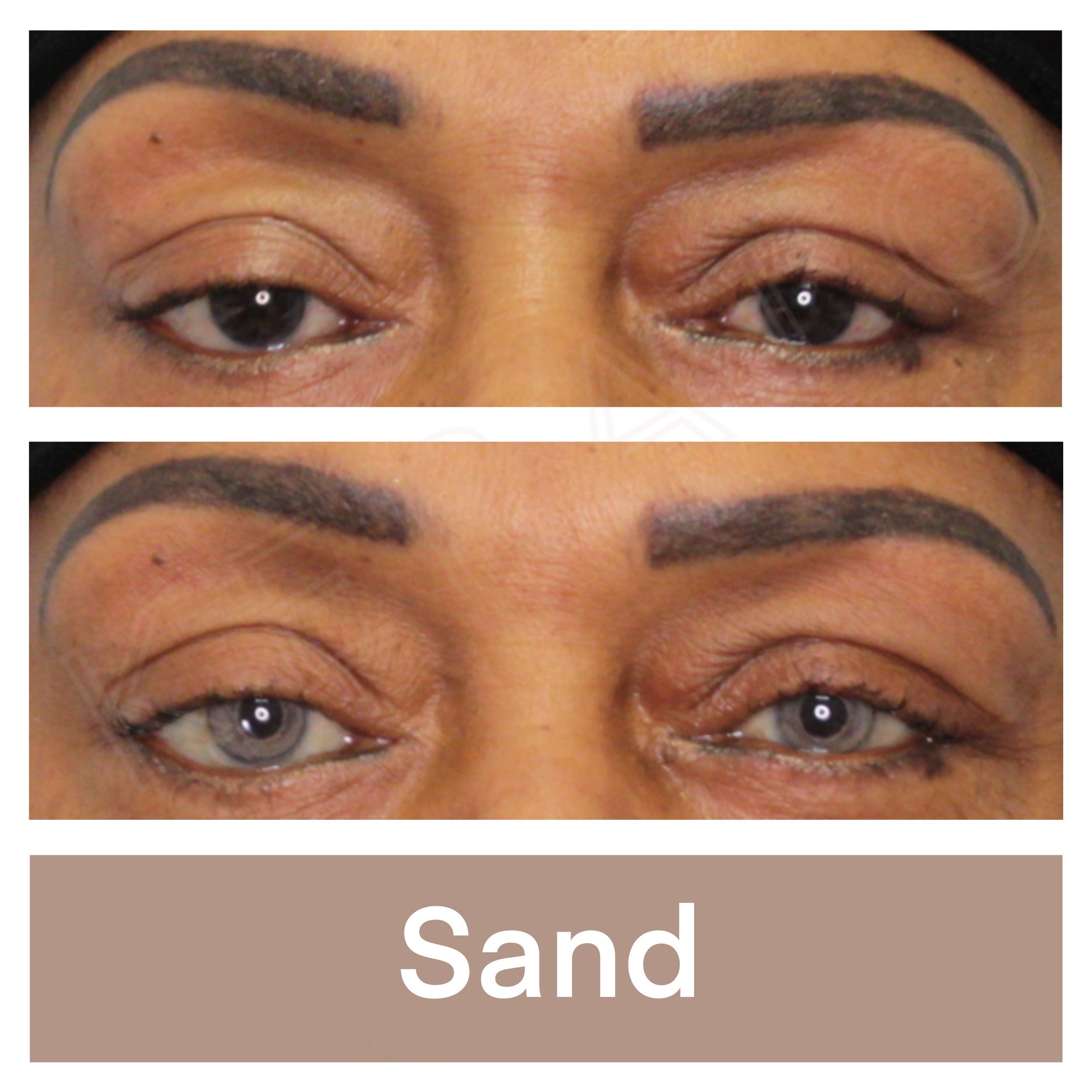 Kerato Procedure with Sand Pigment