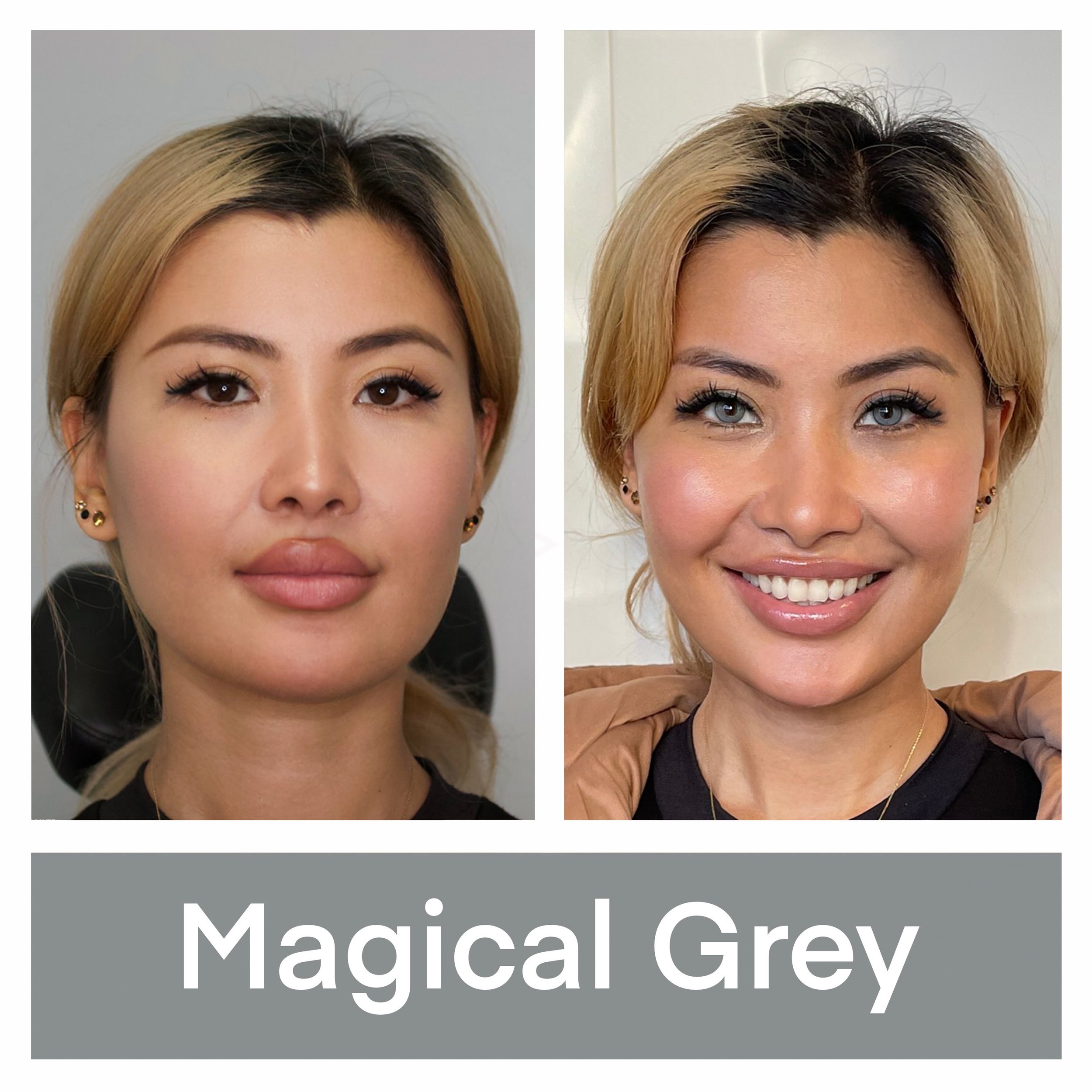Kerato Procedure with Magical Grey Pigment