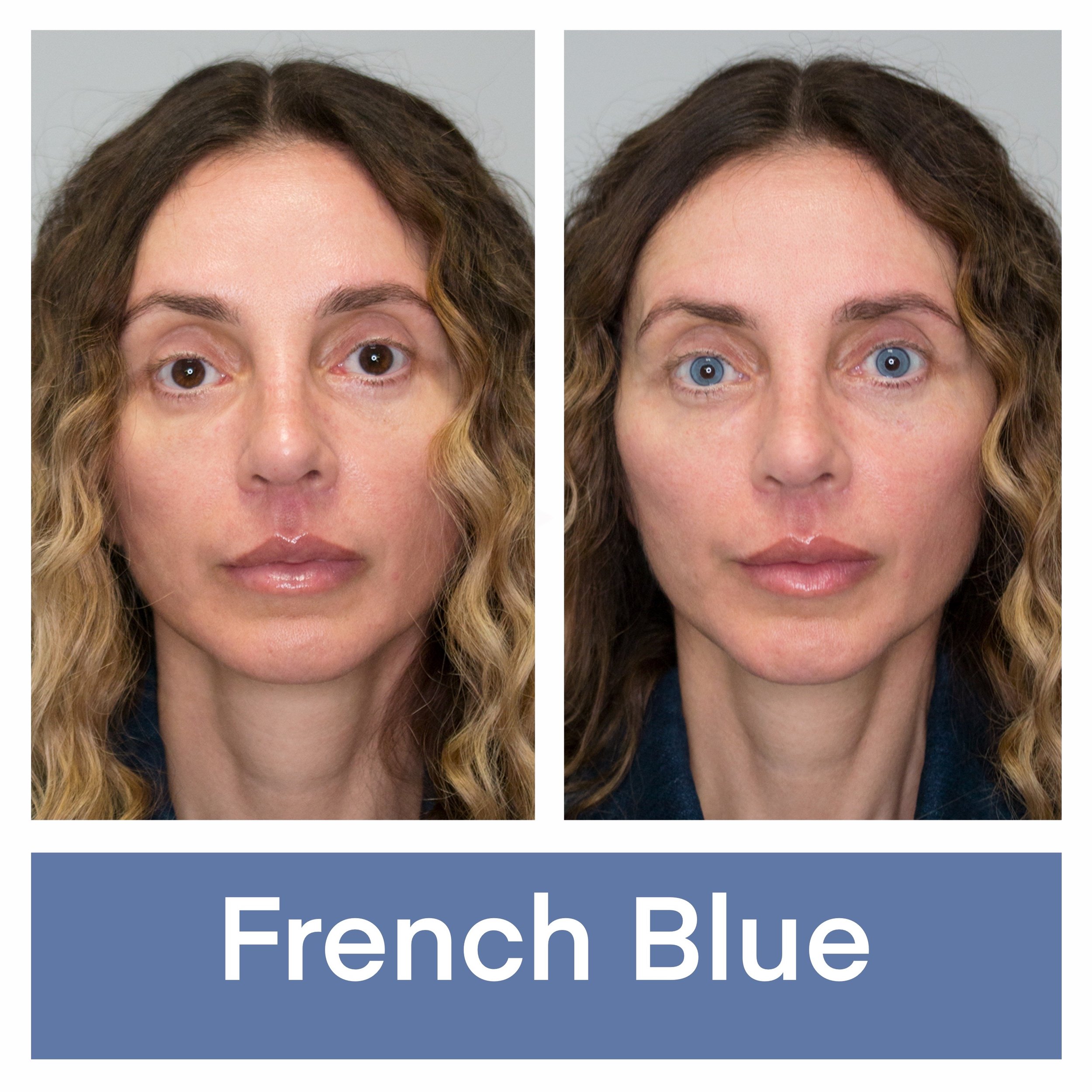 Kerato Procedure with French Blue Pigment