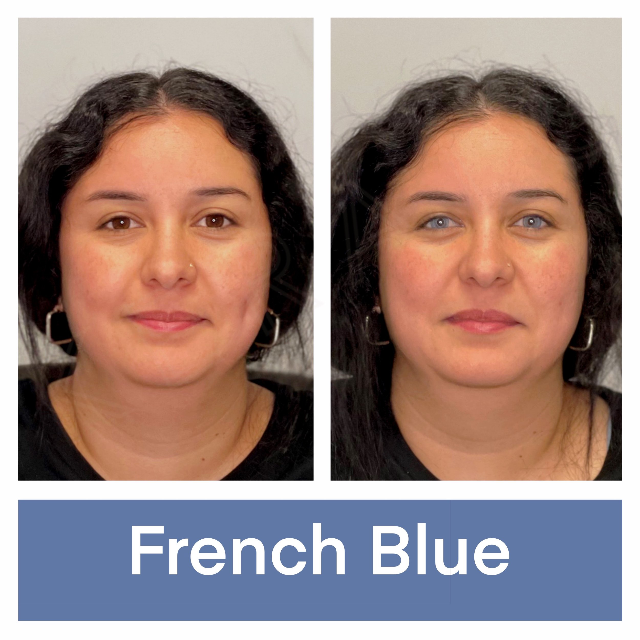 Kerato Procedure with French Blue Pigment