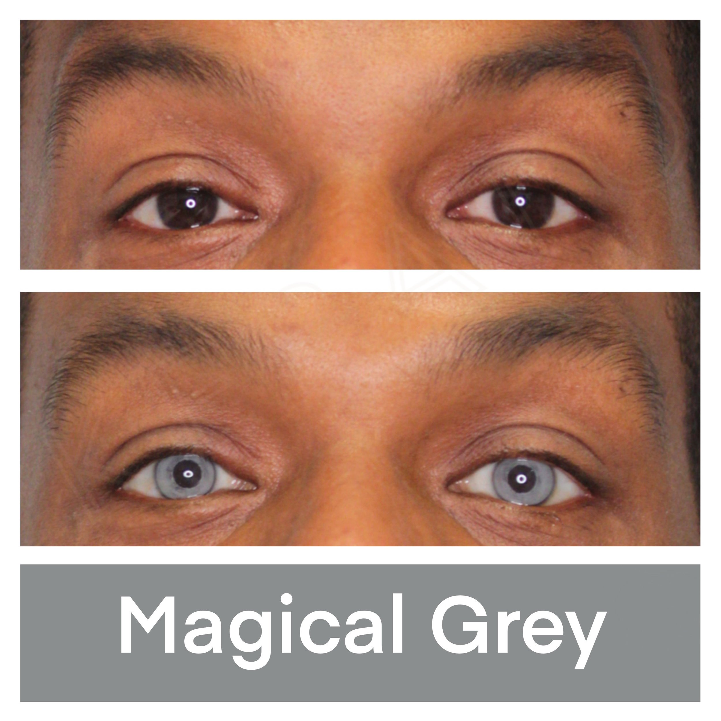 Kerato Procedure with Magical Grey Pigment