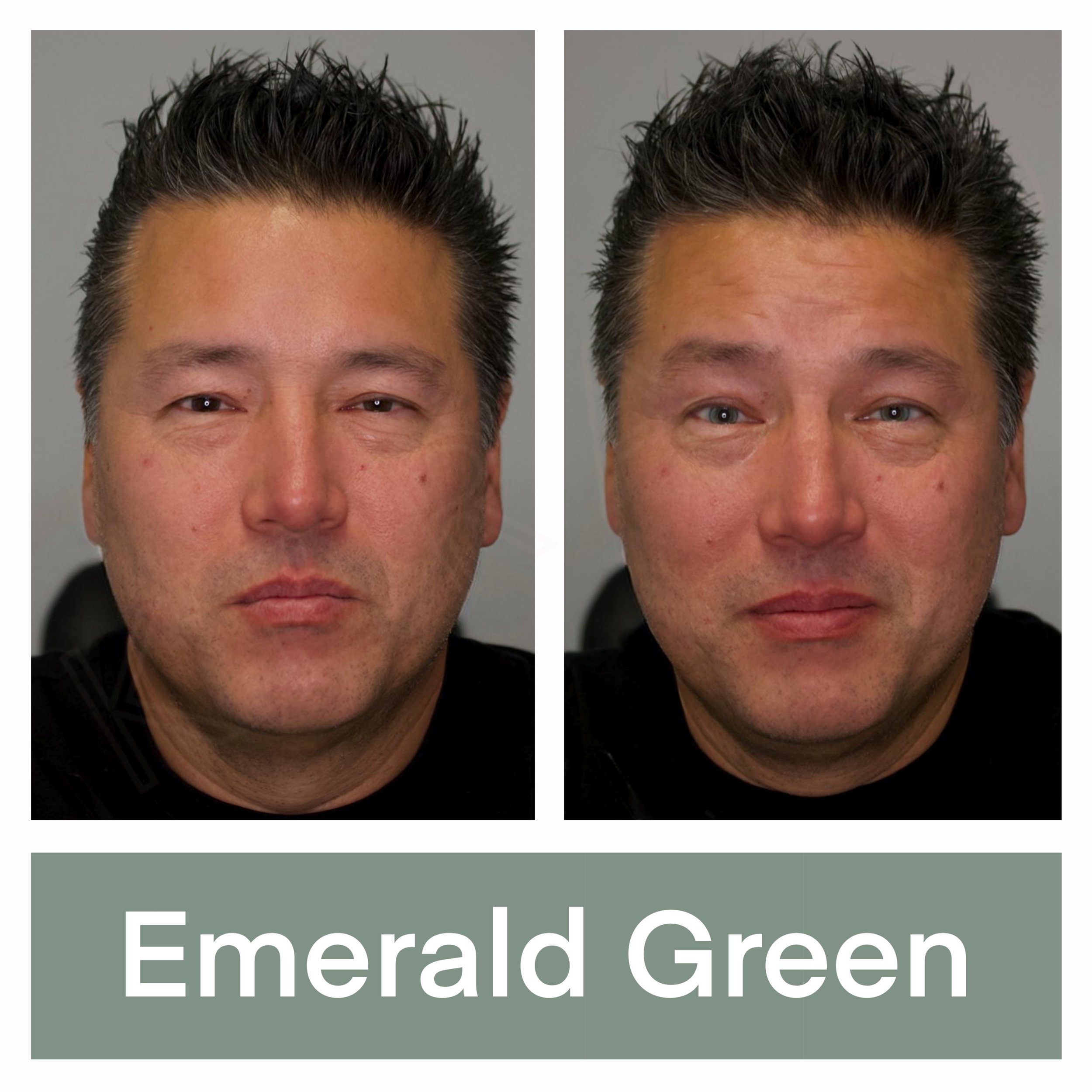 Kerato Procedure with Emerald Green Pigment