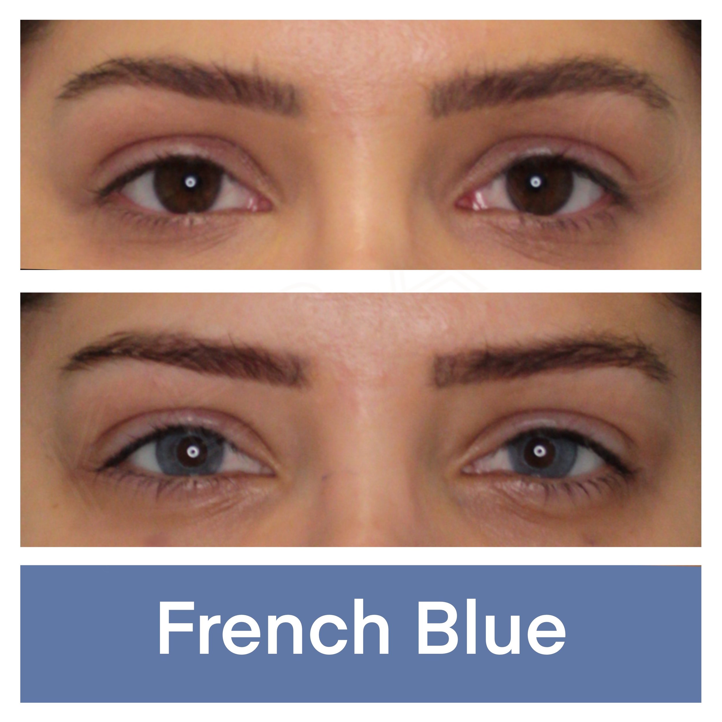 Kerato Procedure with French Blue Pigment