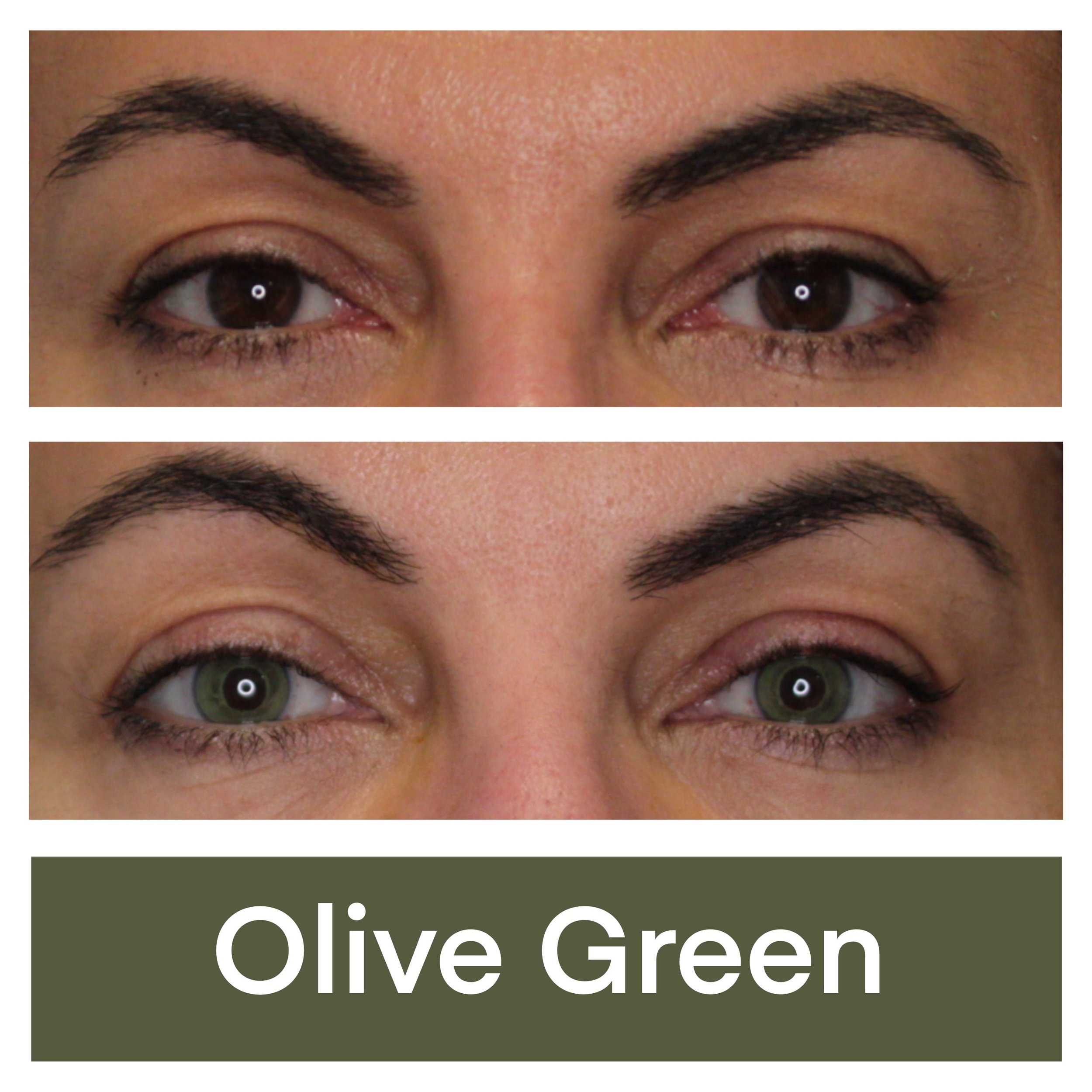 Kerato Procedure with Olive Green Pigment