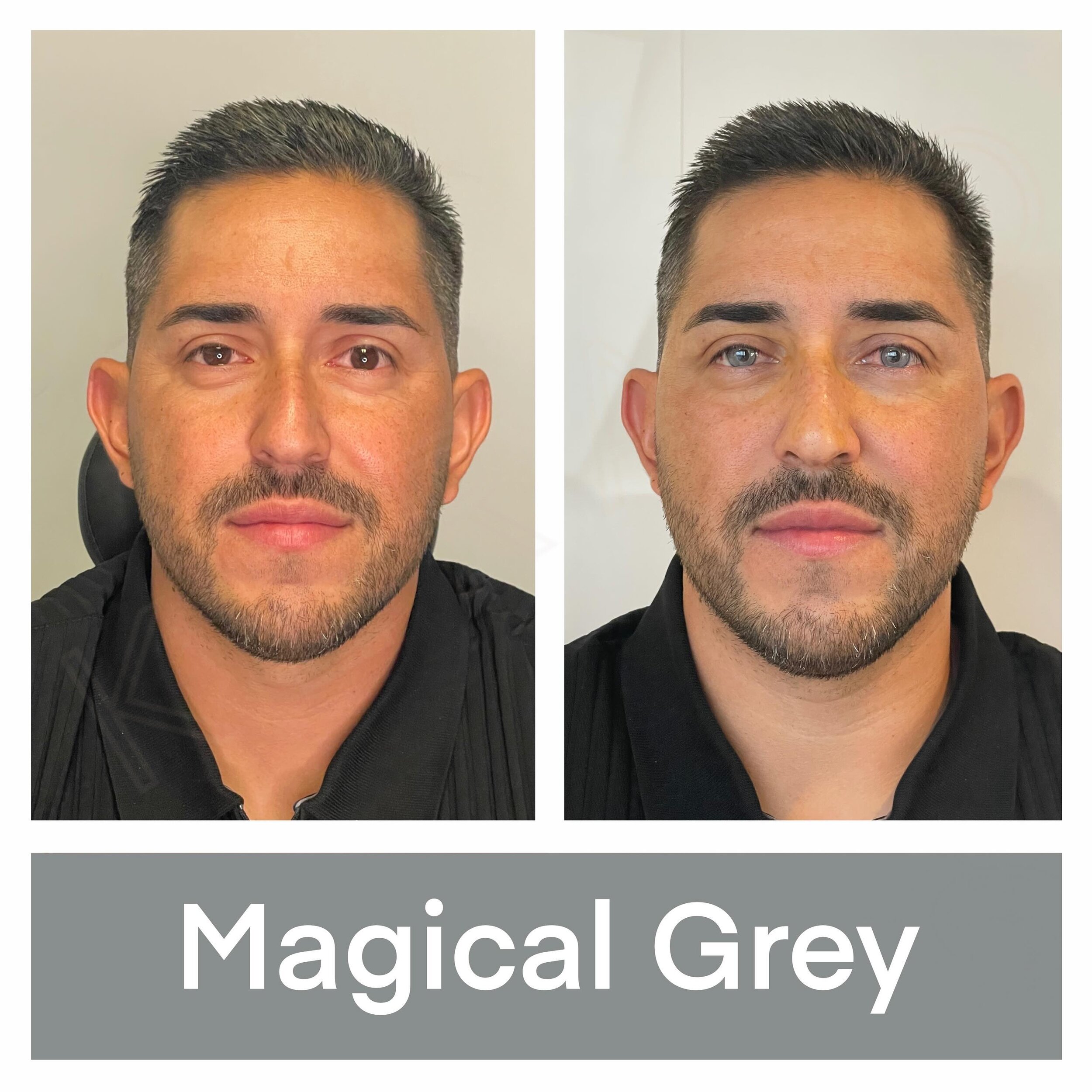 With the safe and precise procedure offered by Kerato NYC, our handsome patient now rocks a striking new look that perfectly complements his style. Say hello to the new you with Kerato NYC! #EyeTransformation #KeratopigmentationSuccess #NewEyesNewYou