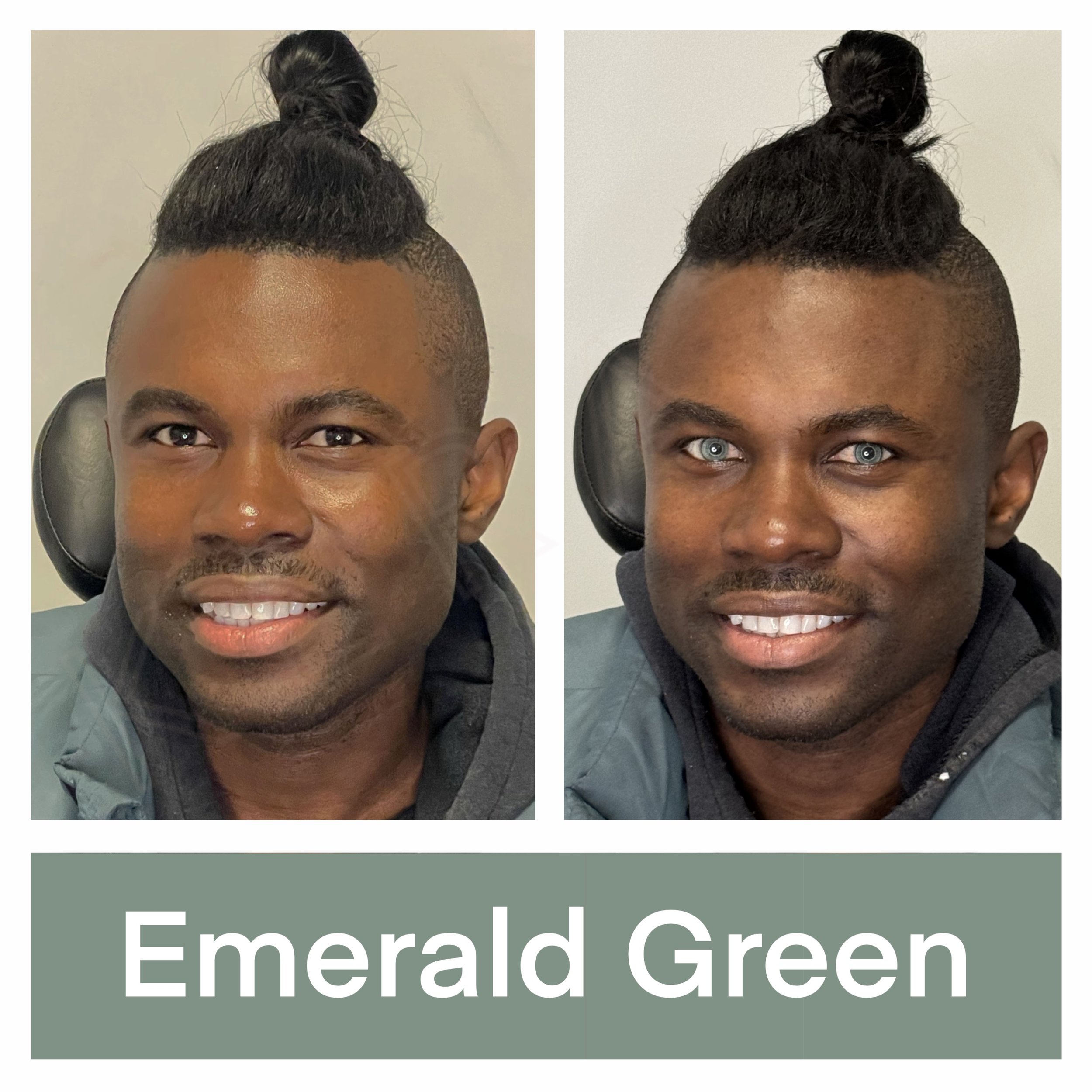 Kerato Procedure with Emerald Green Pigment