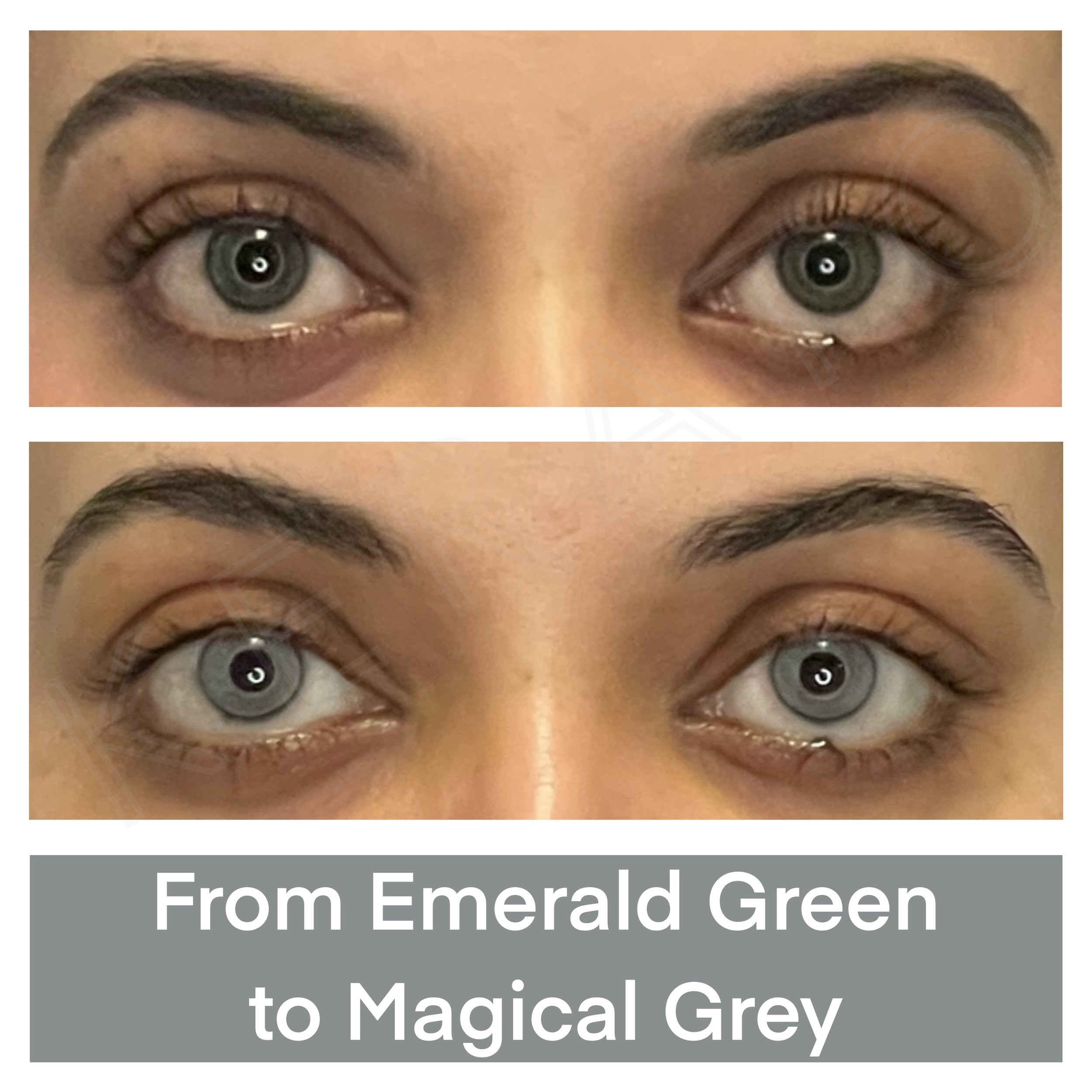 Color correction after the initial keratopigmentation with green color