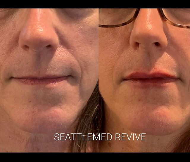 Restalyne silk #lipfillers #fillers #lip