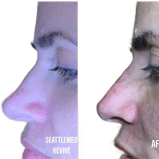 Liquid rhinoplasty only 0.25ml used . It helped smooth out a prior injury.  #rhinoplasty #liquidrhinoplasty #filler