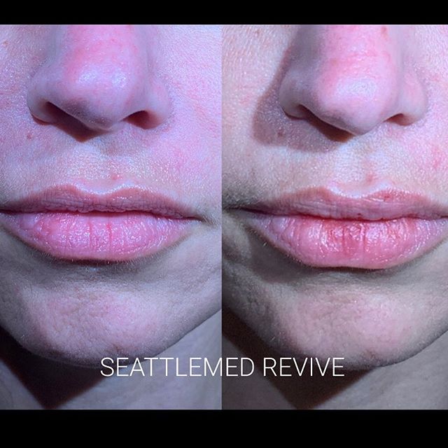 This client only wanted subtle enhancement of her upper lip #lipfillers #fillers #lips