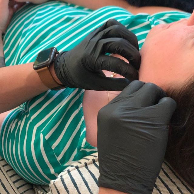 Dr Tran working on sculpting jaw definition and helping our client get ride of what she called her &ldquo;turtleneck&rdquo;. You can see it&rsquo;s practically painless and done with comfort for instant results.  Using some PDO threads and 40min late