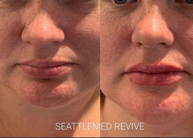 Restalyne silk #lipfillers #fillers #lips