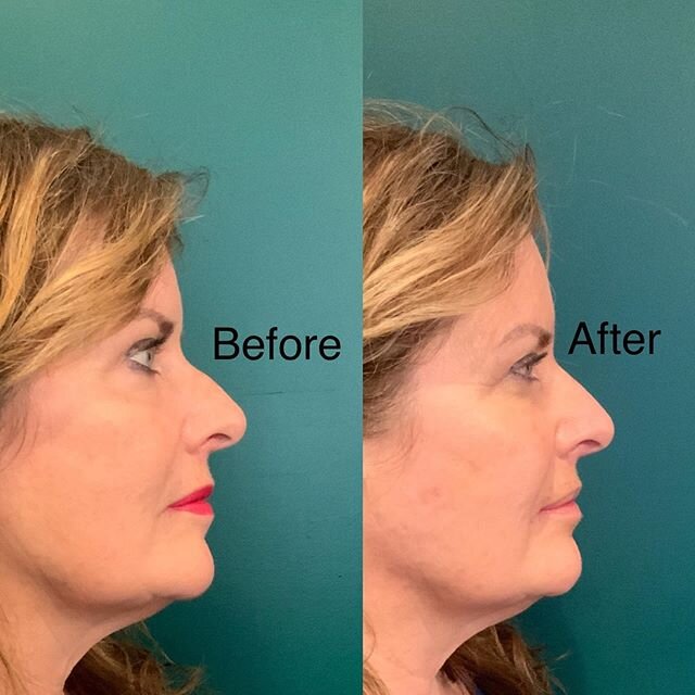 The makeup had to come off yes...... but you can still clearly see the instant results on a liquid rhinoplasty.  She was worried about a &ldquo;hump&rdquo; on the nose. It is quickly and easily fixed without surgery or downtime! (Also what do you thi