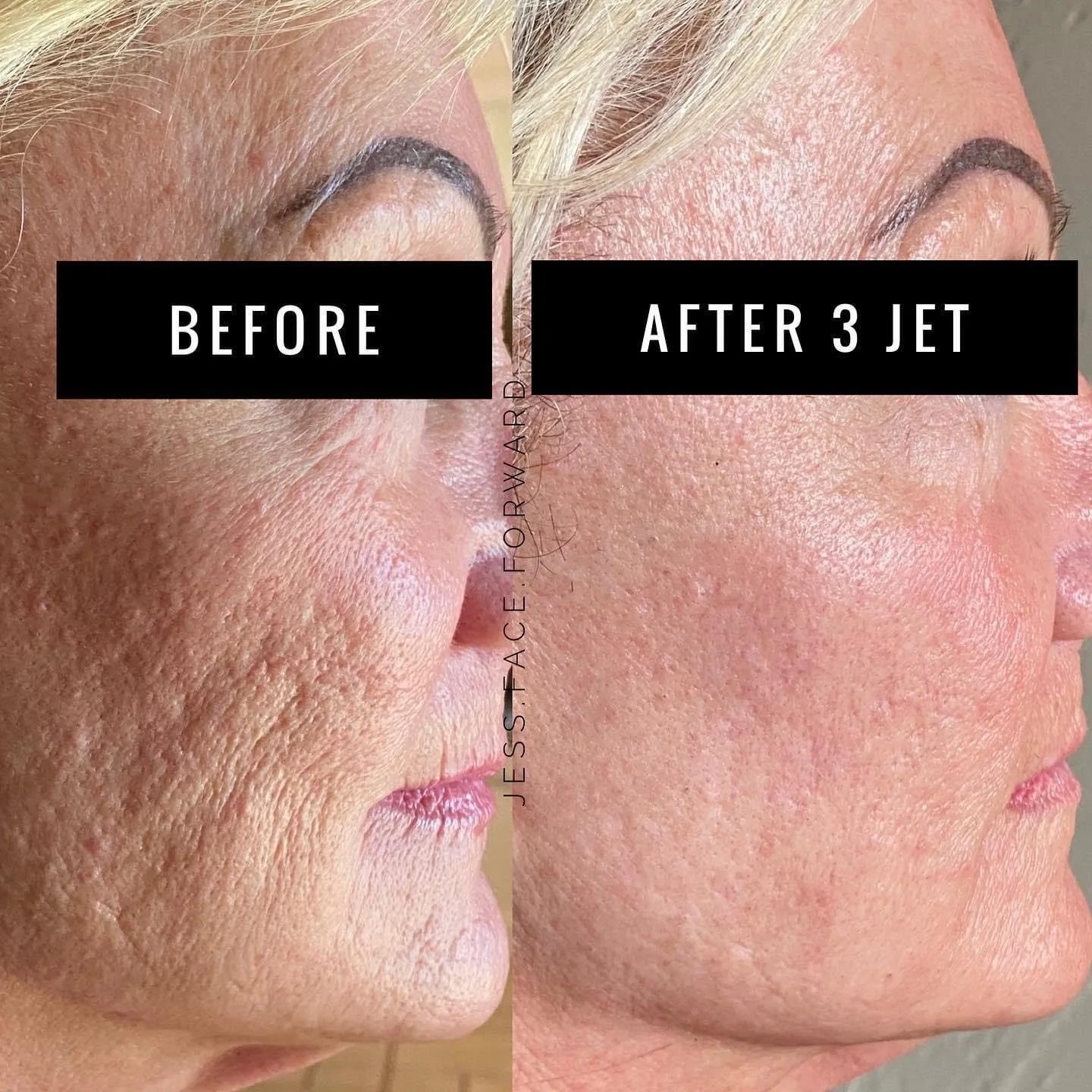 Jet Plasma One Area 3 Sessions