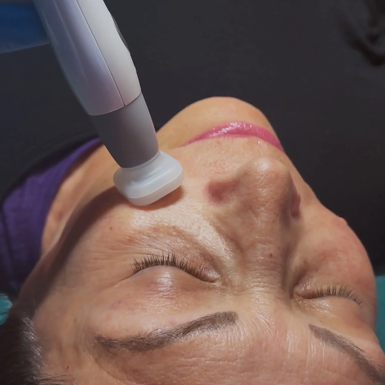 Jet Plasma 2 areas 5 sessions