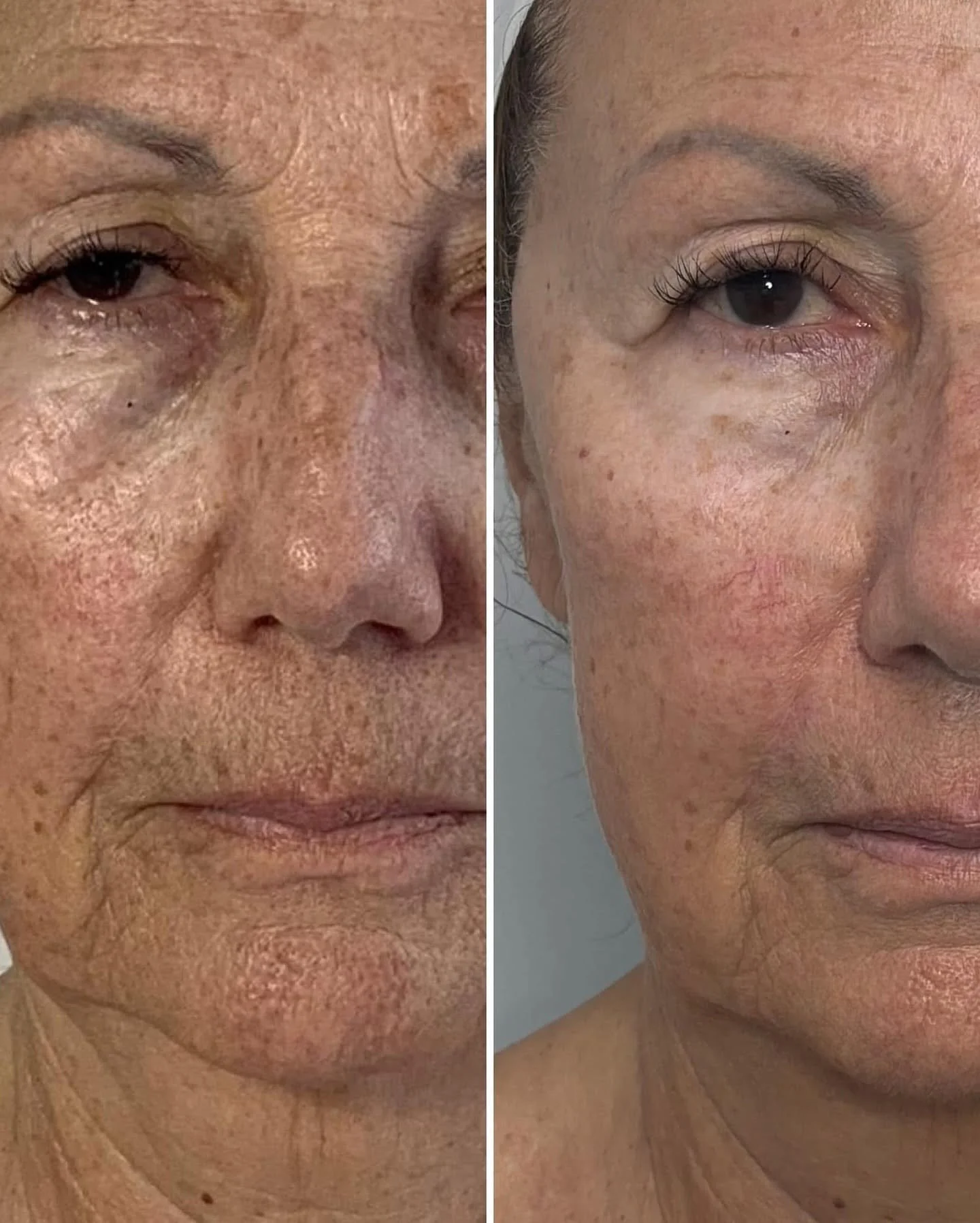 Jet Plasma one area 8 sessions