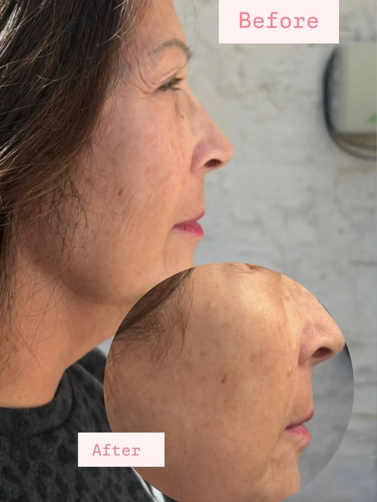 Jet Plasma 2 areas 8 sessions