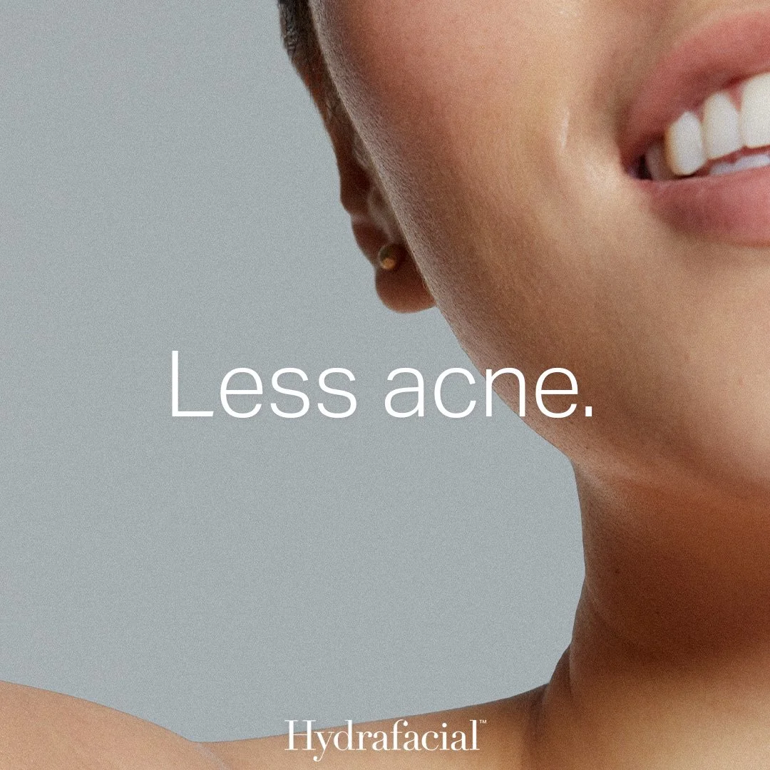 Hydrafacial Acne Awareness
