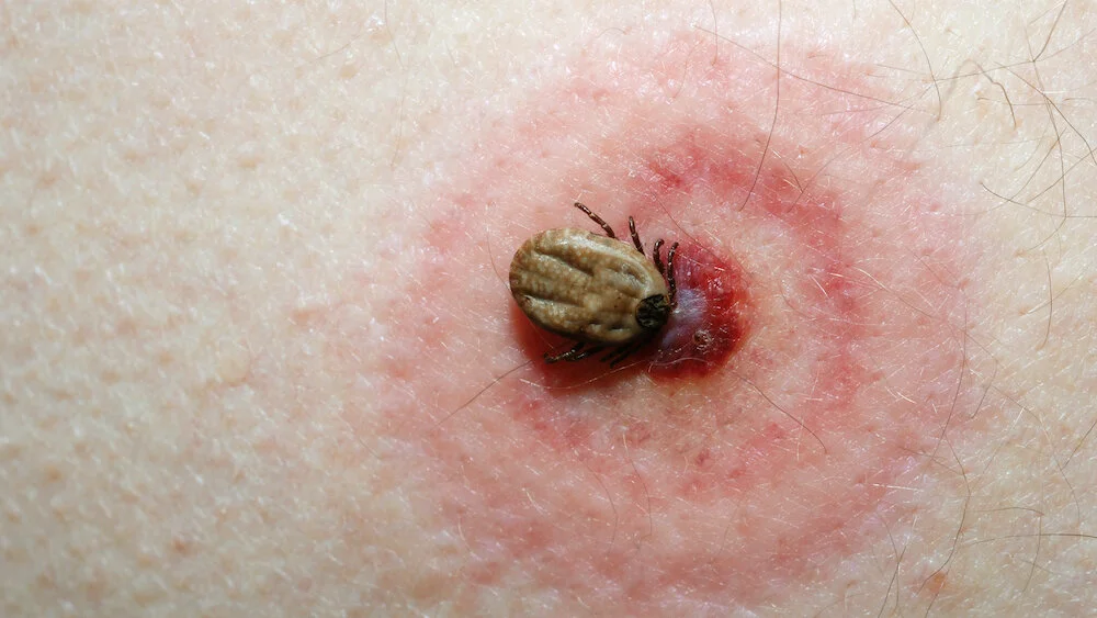 An example of a 'Bulls-eye' rash from a tick bite
