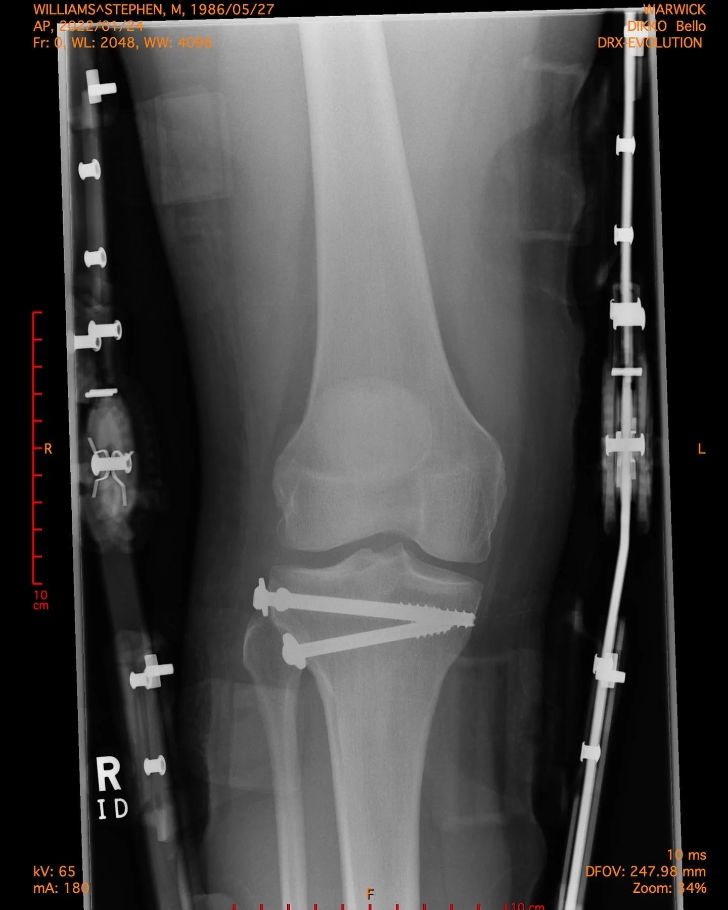 *UPDATED* A personal one My recovery from a tibial plateau fracture