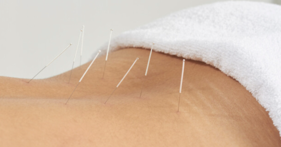 acupuncture on back.png