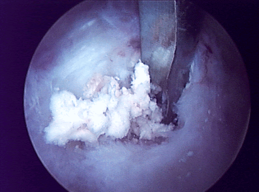 calcific4.gif