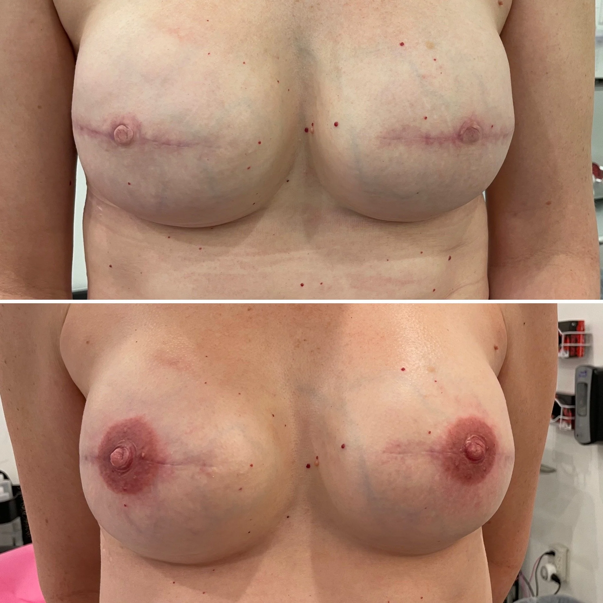 Two side-by-side images of a person's chest showing post-surgical scarring or changes.