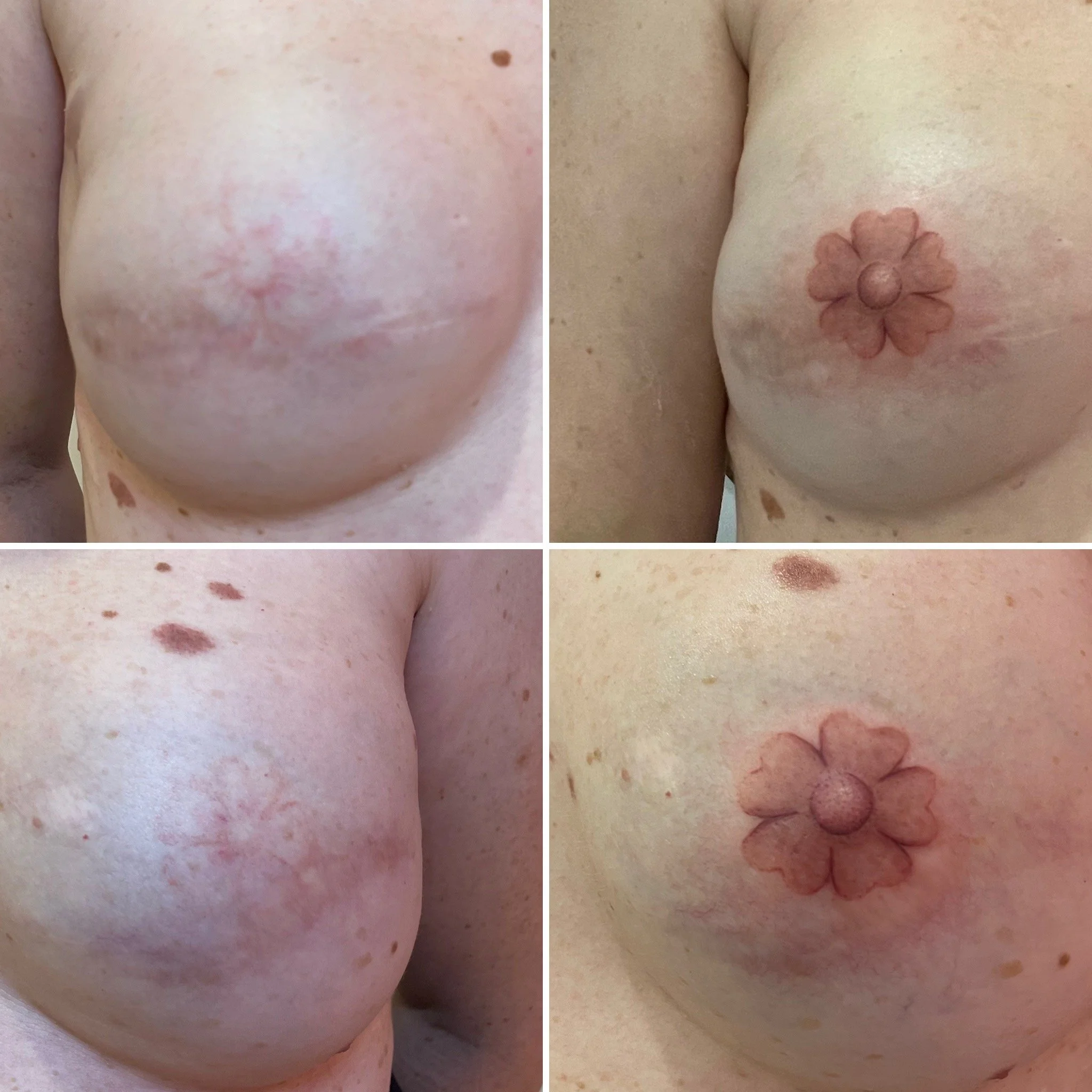 Breast reconstruction showing before and after 3D nipple tattooing with floral design.