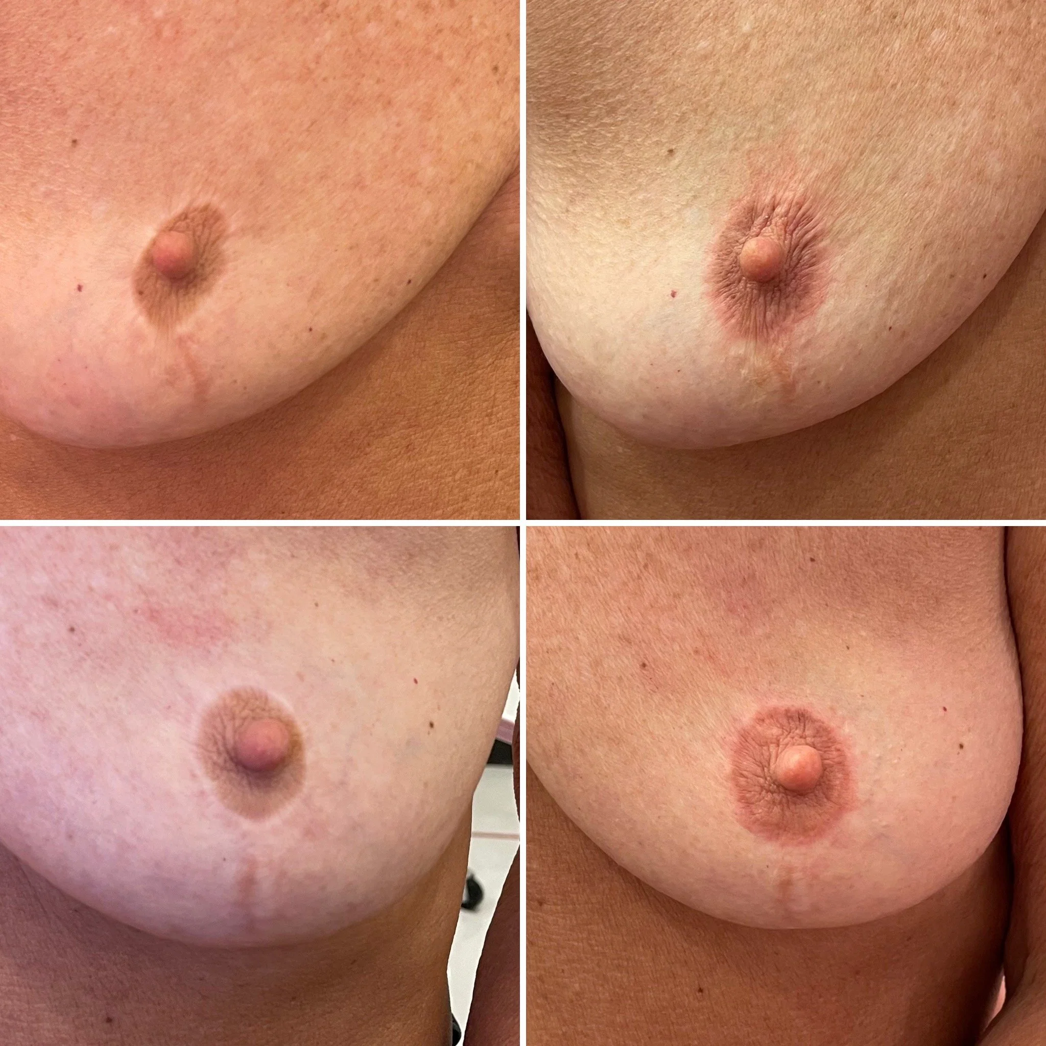 Collage of four close-up images showing skin and nipples, focusing on varied textures and tones.