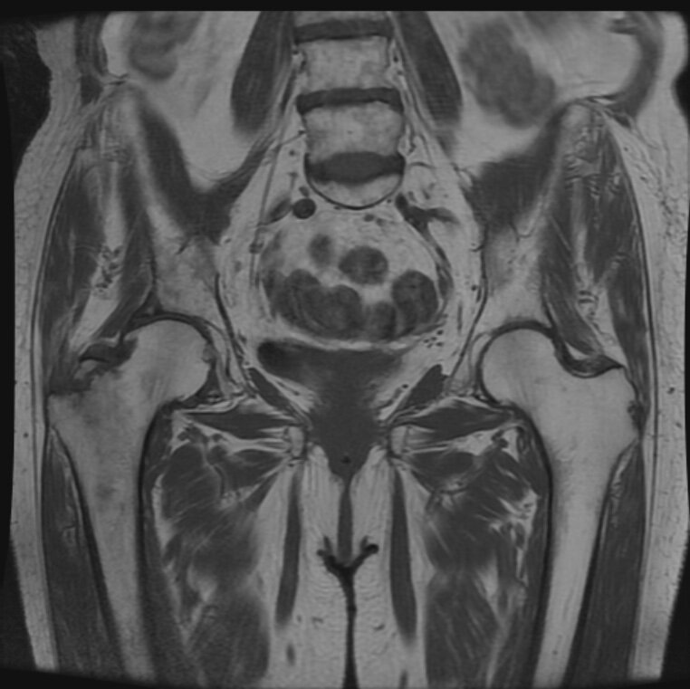 T1 Cor Pelvis.jpg