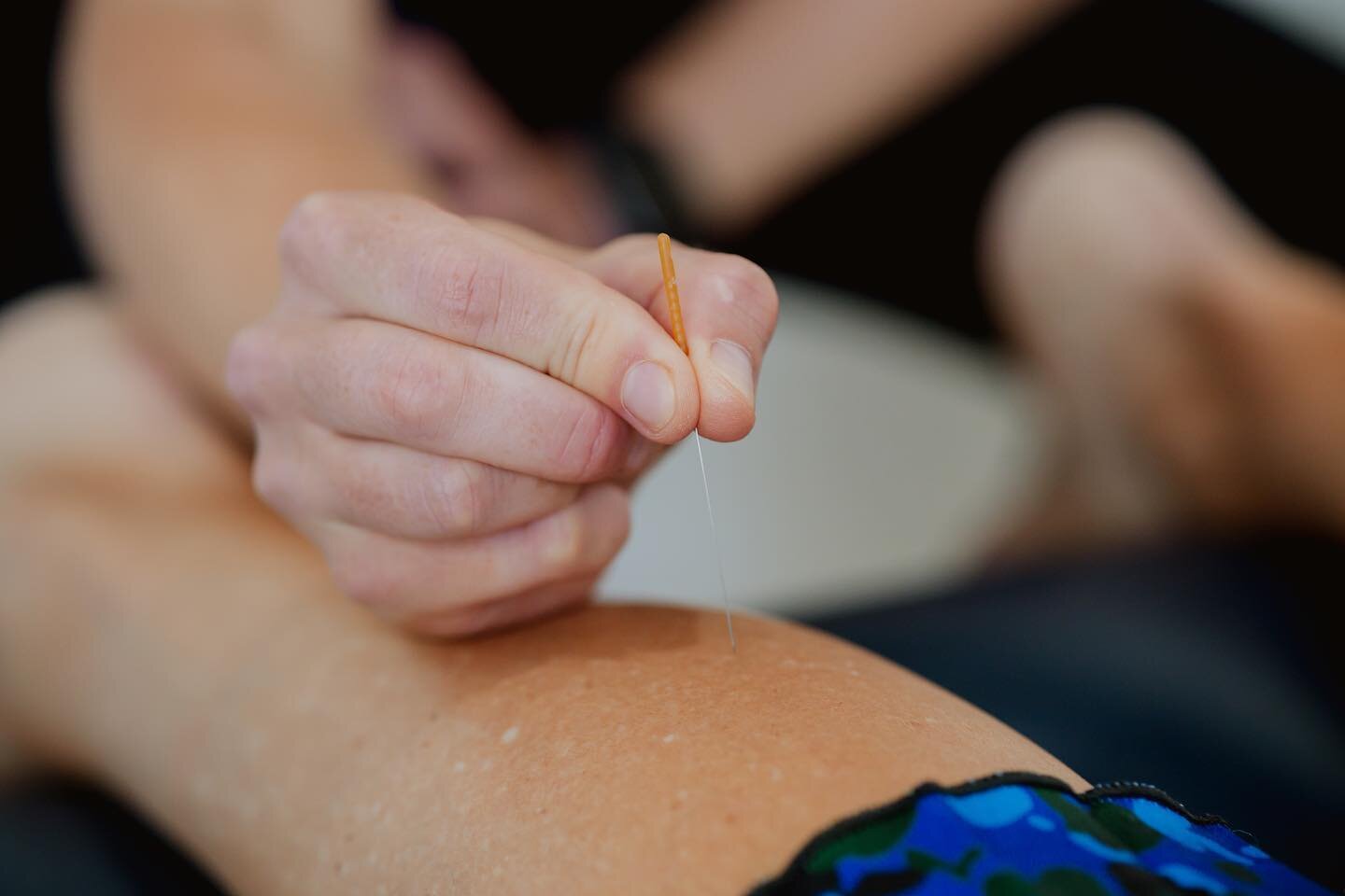 Dry Needling ~ Trigger point therapy is an integral part of how we treat many conditions. This aspect of treatment is used to reduce pain and to improve function.

Combined with manual therapies and rehabilitation exercises and orthotic therapy, acup