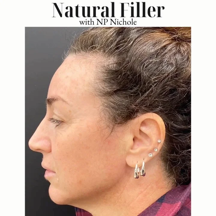 ✨ Before & After ✨
3 syringes may sound like a lot — but when used strategically and by the right injector, the result is beautifully natural 💉
We treated the anterior + lateral cheeks, chin, and pre-jowl sulcus to create a lifted, define