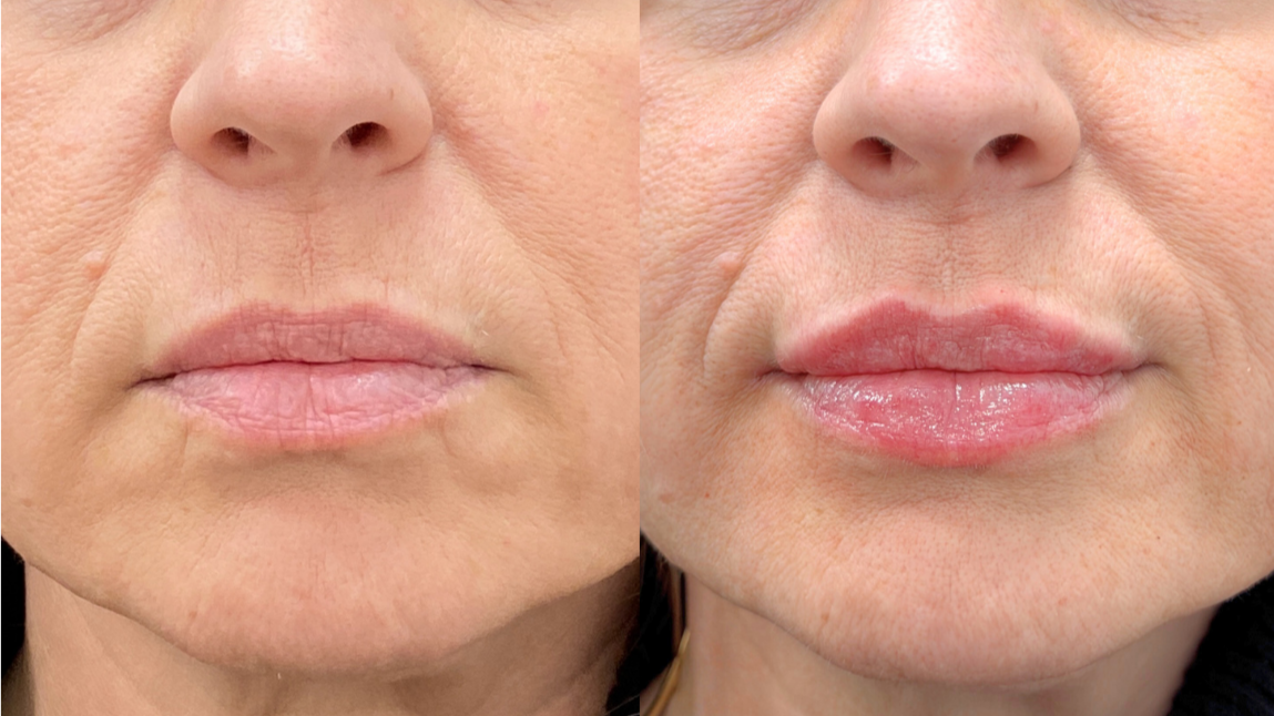 Lip Filler