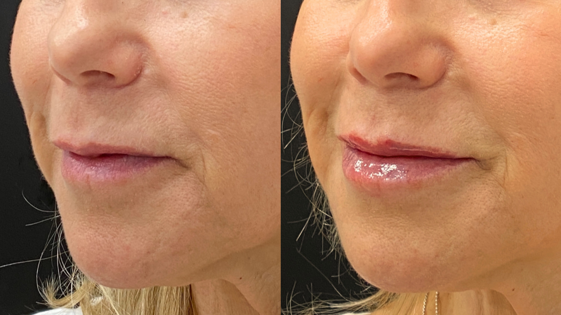 Lip Filler