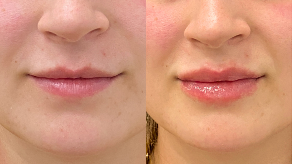 Lip Filler