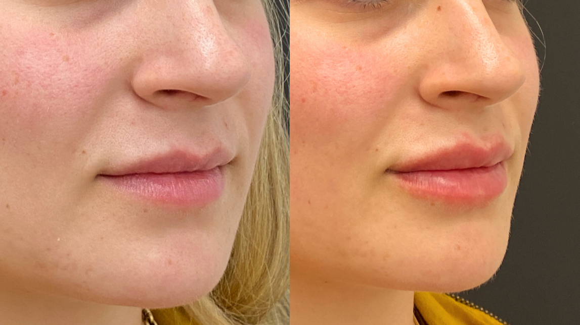 Lip Filler