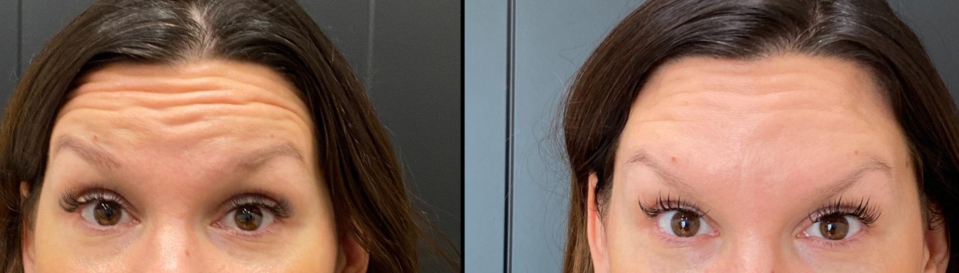 Botox/Dysport/Xeomin/Daxxify